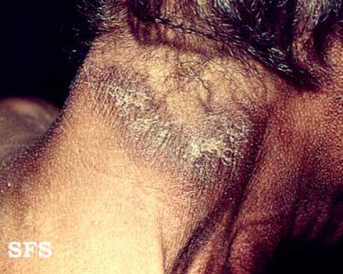 File:Pellagra (Dermatology Atlas 3).jpg