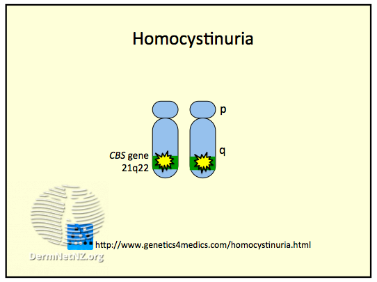 File:*Image courtesy Genetics 4 Medics (DermNet NZ Homocystinuria2).png