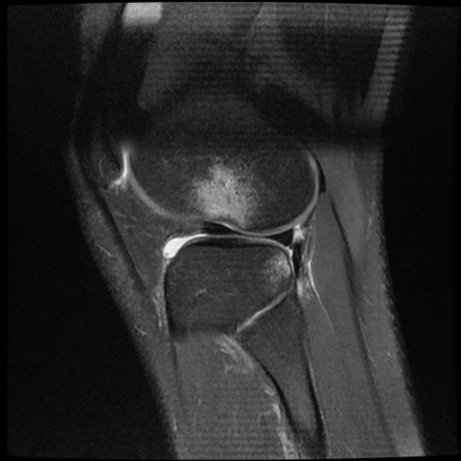 File:ACL acute full thickness tear - deep lateral femoral sulcus sign (Radiopaedia 38594-40740 Sagittal PD fat sat 18).jpg