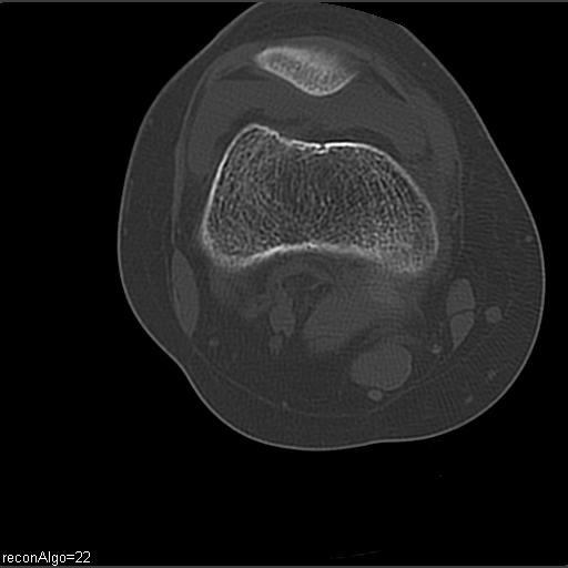 File:ACL avulsion fracture (Radiopaedia 33833-34994 Axial bone window 11).jpg