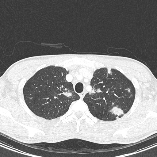 AIDS-related Kaposi sarcoma (Radiopaedia 85247-100811 Axial lung window 34).jpg