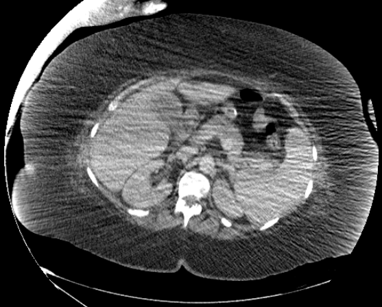 File:Abdominal abscess - pre and post percutaneous drainage (Radiopaedia 60209-67816 Axial 61).png