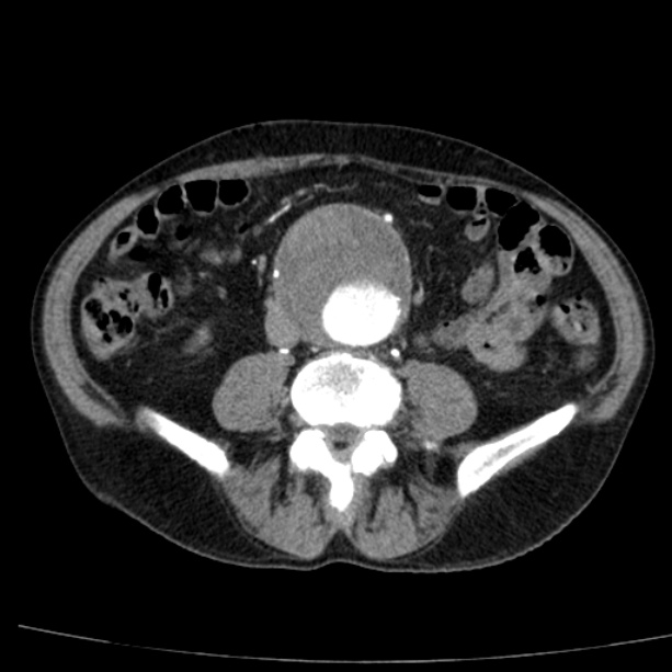 Abdominal aortic aneurysm (Radiopaedia 29248-29660 Axial C+ arterial phase 51).jpg