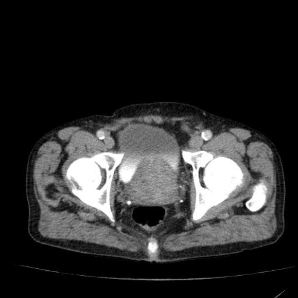 Abdominal aortic aneurysm (Radiopaedia 29248-29660 Axial C+ portal venous phase 59).jpg