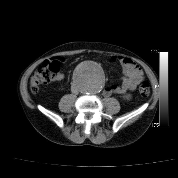 Abdominal aortic aneurysm (Radiopaedia 29248-29660 Axial non-contrast 35).jpg