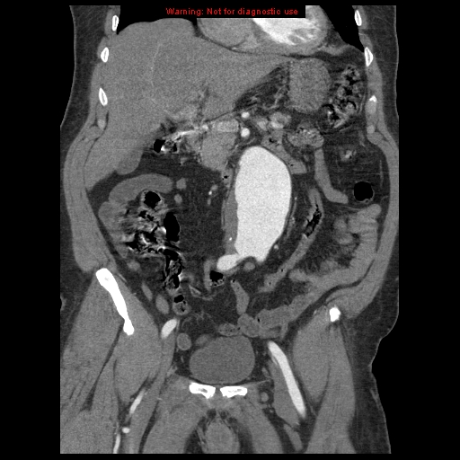 Abdominal aortic aneurysm (Radiopaedia 8190-9038 Coronal C+ arterial phase 49).jpg