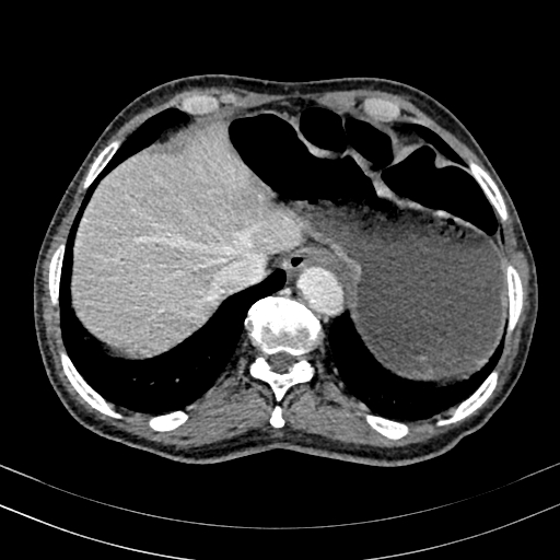 Abdominal aortic aneurysm (Radiopaedia 83581-98689 Axial C+ portal venous phase 15).jpg