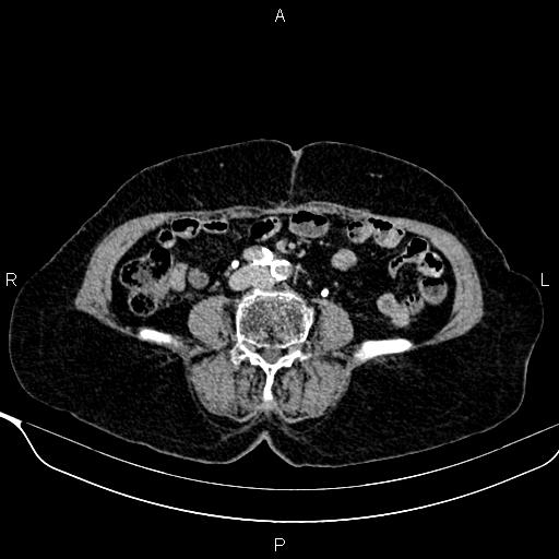 Abdominal aortic aneurysm (Radiopaedia 85063-100606 Axial C+ delayed 83).jpg
