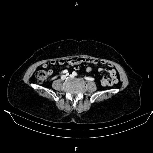 File:Abdominal aortic aneurysm (Radiopaedia 85063-100606 Axial C+ portal venous phase 49).jpg
