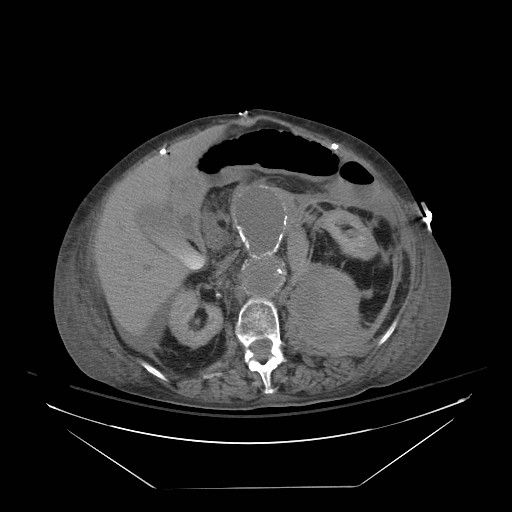 Abdominal aortic aneurysm - impending rupture (Radiopaedia 19233-19247 Axial non-contrast 71).jpg