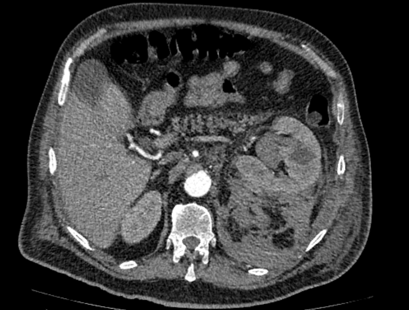 Abdominal aortic aneurysm rupture (Radiopaedia 54179-60362 Axial C+ arterial phase 25).jpg