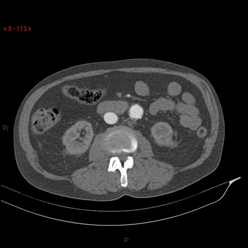 Abdominal aortic aneurysm rupture with aortocaval fistula (Radiopaedia 14897-14841 Axial C+ arterial phase 113).jpg