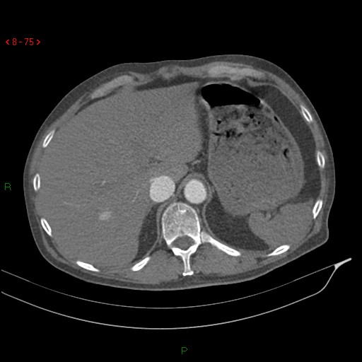 Abdominal aortic aneurysm rupture with aortocaval fistula (Radiopaedia 14897-14841 Axial C+ arterial phase 75).jpg