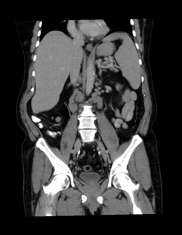 Abdominal lymphoma - with sandwich sign (Radiopaedia 53486-59492 C+ portal venous phase 26).jpg