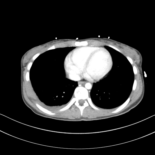 File:Abdominal multi-trauma - devascularised kidney and liver, spleen and pancreatic lacerations (Radiopaedia 34984-36486 Axial C+ portal venous phase 3).png