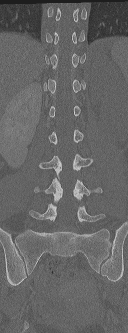 Abdominal multi-trauma - devascularised kidney and liver, spleen and pancreatic lacerations (Radiopaedia 34984-36486 Coronal bone window 42).png
