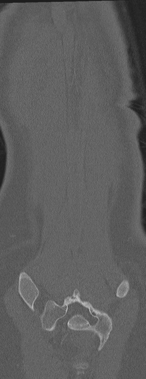 Abdominal multi-trauma - devascularised kidney and liver, spleen and pancreatic lacerations (Radiopaedia 34984-36486 Coronal bone window 66).png