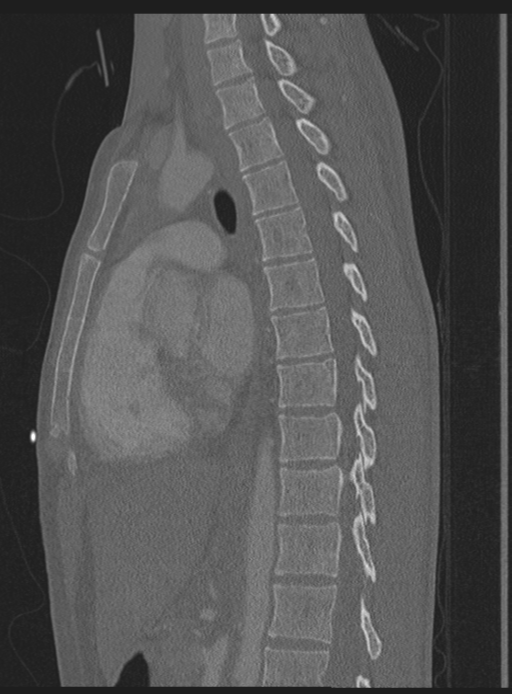 Abdominal multi-trauma - devascularised kidney and liver, spleen and pancreatic lacerations (Radiopaedia 34984-36486 Sagittal bone window 30).png
