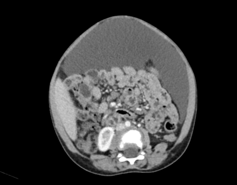 Abdominal premesenteric cystic lymphangioma (Radiopaedia 82995-97350 Axial C+ portal venous phase 33).jpg
