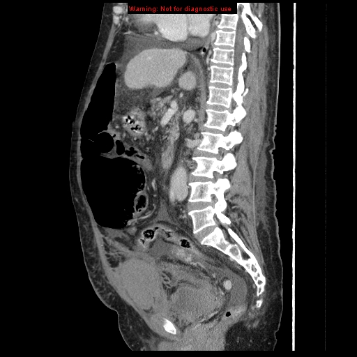 Abdominal wall hematoma (Radiopaedia 9427-10112 Sagittal C+ portal venous phase 55).jpg