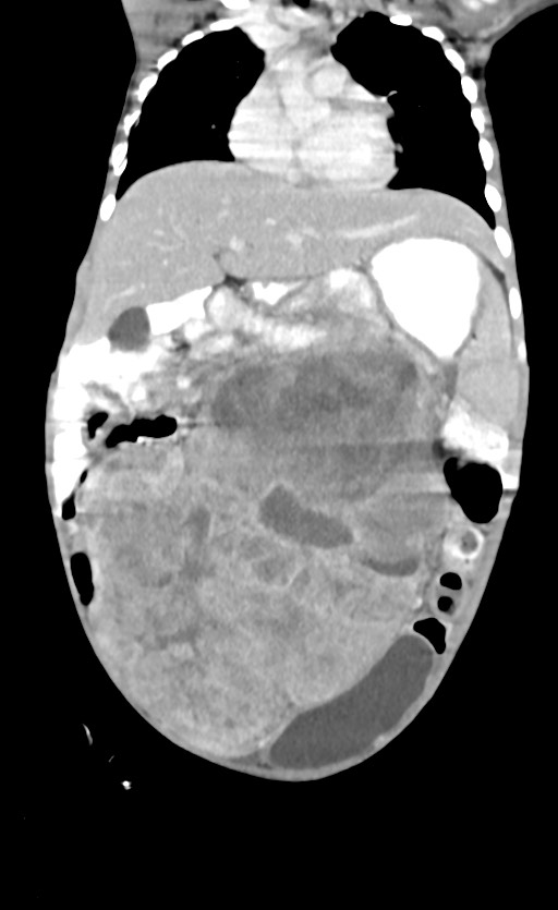 Abdominopelvic rhabdomyosarcoma (Radiopaedia 78356-90984 Coronal C+ portal venous phase 35).jpg