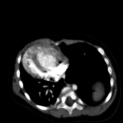 File:Aberrant left pulmonary artery (pulmonary sling) (Radiopaedia 42323-45435 Axial C+ CTPA 32).jpg