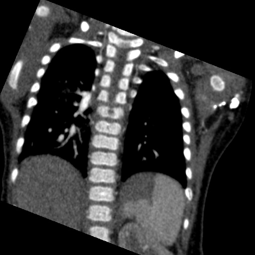 File:Aberrant left pulmonary artery (pulmonary sling) (Radiopaedia 42323-45435 Coronal C+ CTPA 8).jpg