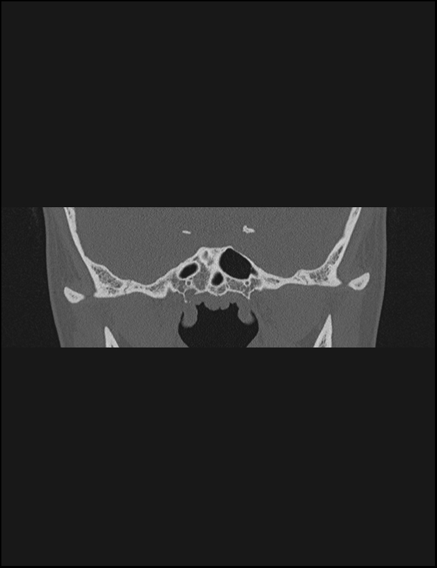 Aberrant right internal carotid artery (Radiopaedia 65191-74198 Coronal non-contrast 5).jpg
