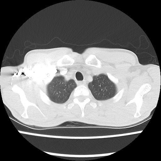 Accessory left horizontal fissure with lingular pneumonia (Radiopaedia 53763-59843 Axial lung window 9).jpg