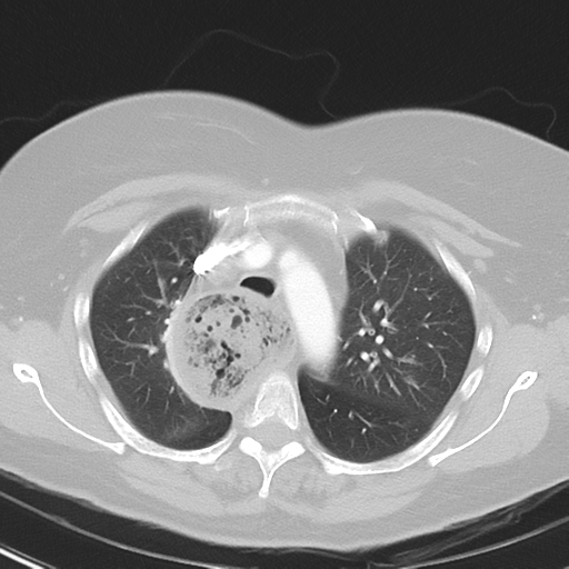 File:Achalasia (Radiopaedia 47147-51685 Axial lung window 15).png