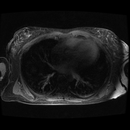 Acinar cell carcinoma of the pancreas (Radiopaedia 75442-86668 Axial late phase (~30 mins) 148).jpg