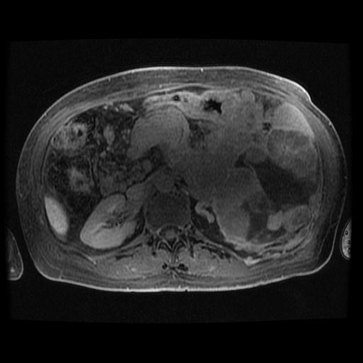 Acinar cell carcinoma of the pancreas (Radiopaedia 75442-86668 Axial late phase (~30 mins) 50).jpg