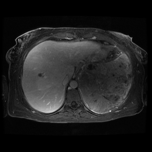 Acinar cell carcinoma of the pancreas (Radiopaedia 75442-86668 D 112).jpg