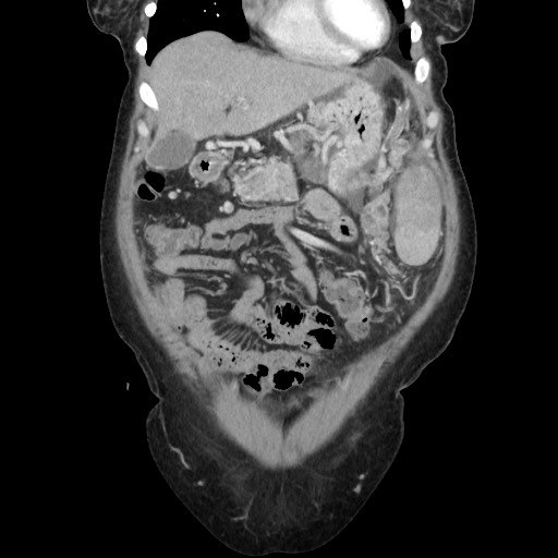 Acinar cell carcinoma of the pancreas (Radiopaedia 75442-86669 Coronal C+ portal venous phase 33).jpg
