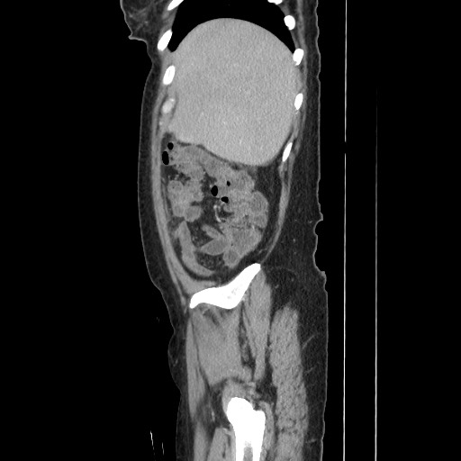 Acinar cell carcinoma of the pancreas (Radiopaedia 75442-86669 Sagittal C+ portal venous phase 43).jpg