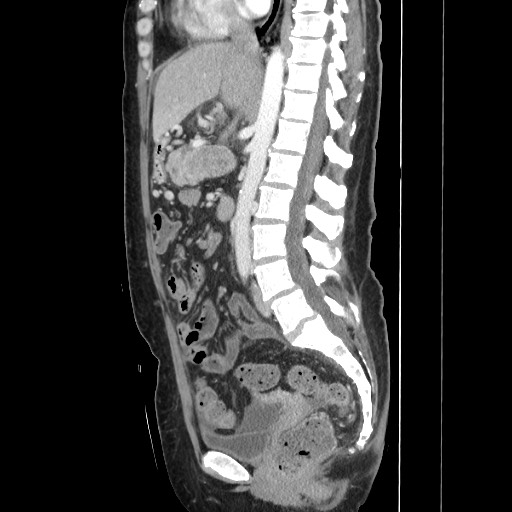 File:Acinar cell carcinoma of the pancreas (Radiopaedia 75442-86669 Sagittal C+ portal venous phase 97).jpg