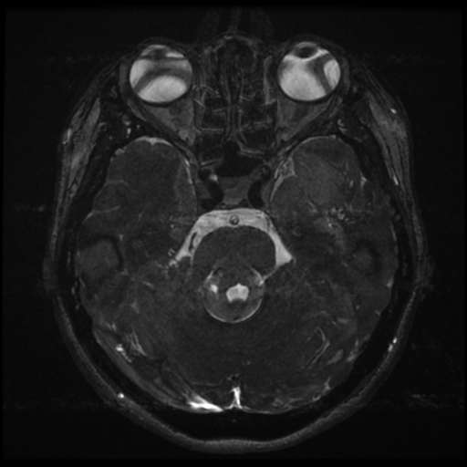Acoustic neuroma (Radiopaedia 34049-35283 Axial 78).png