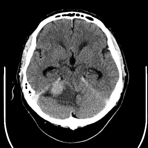 File:Acoustic schwannoma (Radiopaedia 39170-41389 Axial C+ 10).png