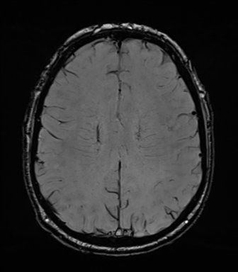Acoustic schwannoma (Radiopaedia 50846-56358 Axial SWI 63).png