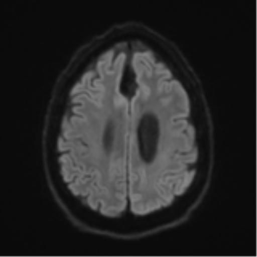 File:Acoustic schwannoma (Radiopaedia 55729-62281 E 48).png