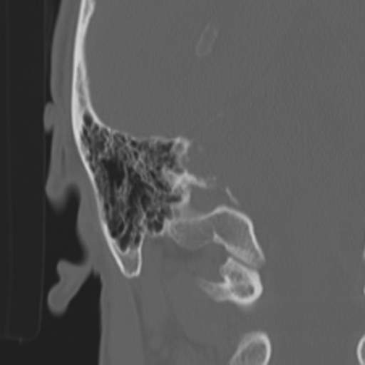 Acoustic schwannoma - eroding petrous apex (Radiopaedia 39674-42002 Coronal bone window 44).png
