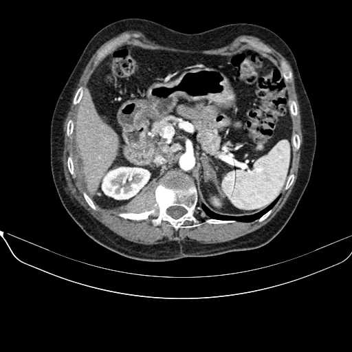 File:Acquired adrenal hyperplasia - due to thymic carcinoid tumor (Radiopaedia 21269-21184 C+ arterial phase 35).jpg