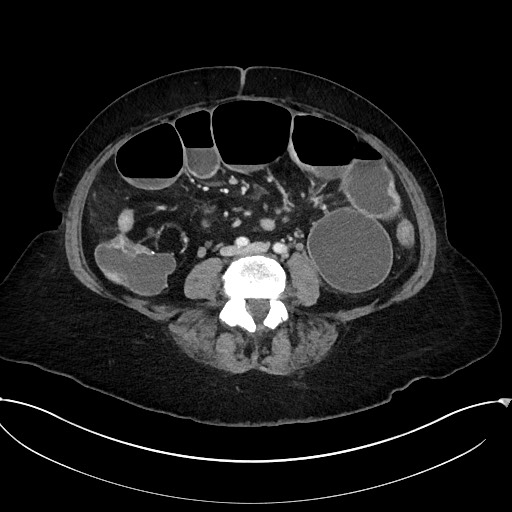 Active Crohn disease (Radiopaedia 59394-66750 Axial C+ portal venous phase 44).jpg