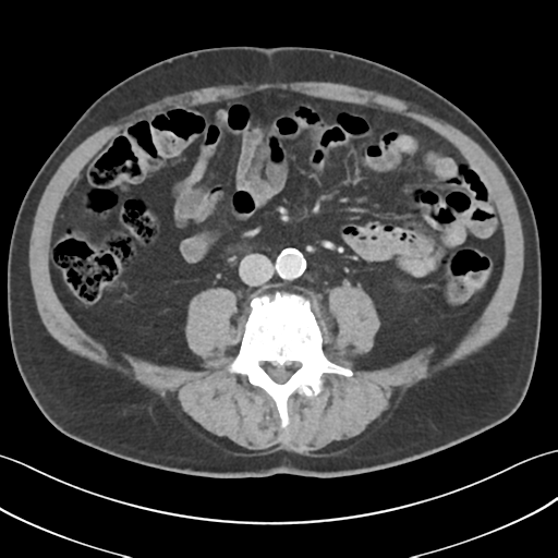File:Active diverticular hemorrhage (Radiopaedia 39415-41725 Axial C+ portal venous phase 37).png