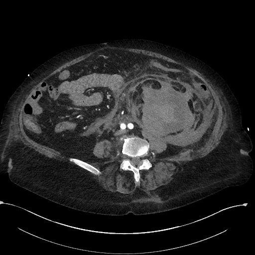 Active renal extravasation with large subcapsular and retroperitoneal hemorrhage (Radiopaedia 60975-68796 Axial C+ arterial phase 114).jpg