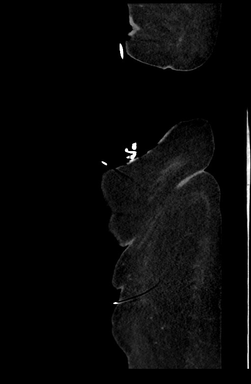 Active renal extravasation with large subcapsular and retroperitoneal hemorrhage (Radiopaedia 60975-68796 Sagittal C+ portal venous phase 23).jpg