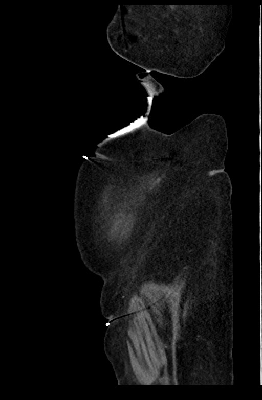 Active renal extravasation with large subcapsular and retroperitoneal hemorrhage (Radiopaedia 60975-68796 Sagittal C+ portal venous phase 32).jpg