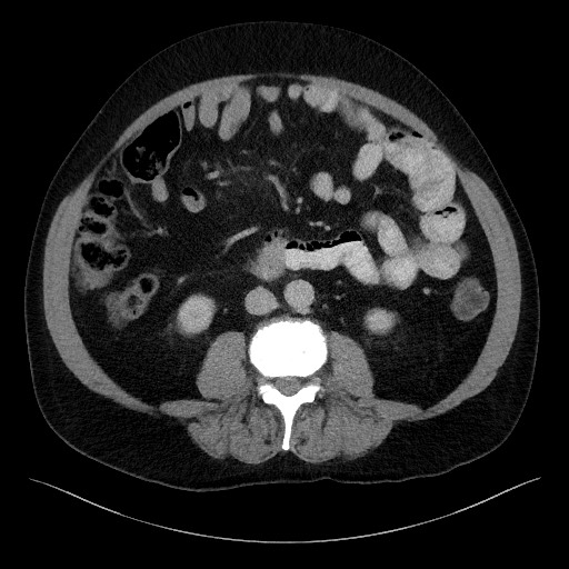 Acute-on-chronic pancreatitis (Radiopaedia 67286-76656 Axial C+ portal venous phase 42).jpg