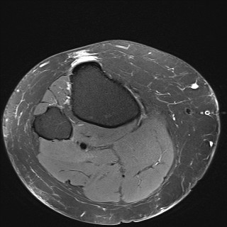 File:Acute-on-chronic transient lateral patellar dislocation with trochlear dysplasia (Radiopaedia 84099-99349 Axial PD fat sat 34).jpg