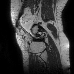Acute-on-chronic transient lateral patellar dislocation with trochlear dysplasia (Radiopaedia 84099-99349 Sagittal PD 130).jpg